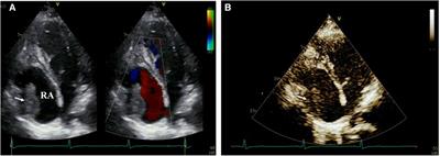 Case Report: A case of Crohn's disease with right atrial thrombosis